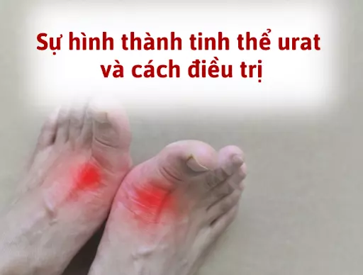 Sự hình thành tinh thể urat ở bệnh gout và cách điều trị